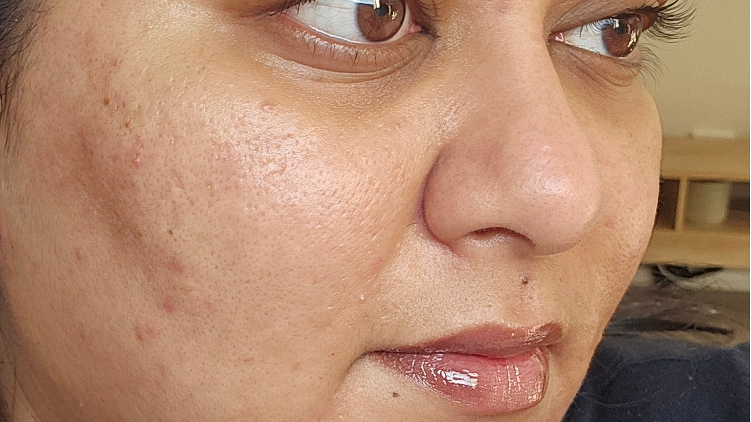 How do you get rid of spots? 5 step get rid of spots guide