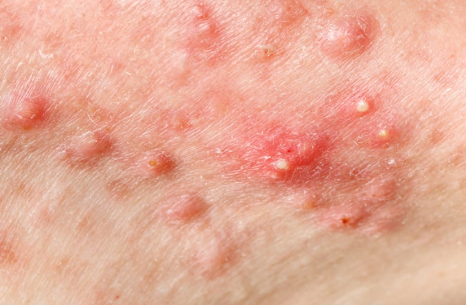 How do you remove pimples? A holistic approach to clearer skin