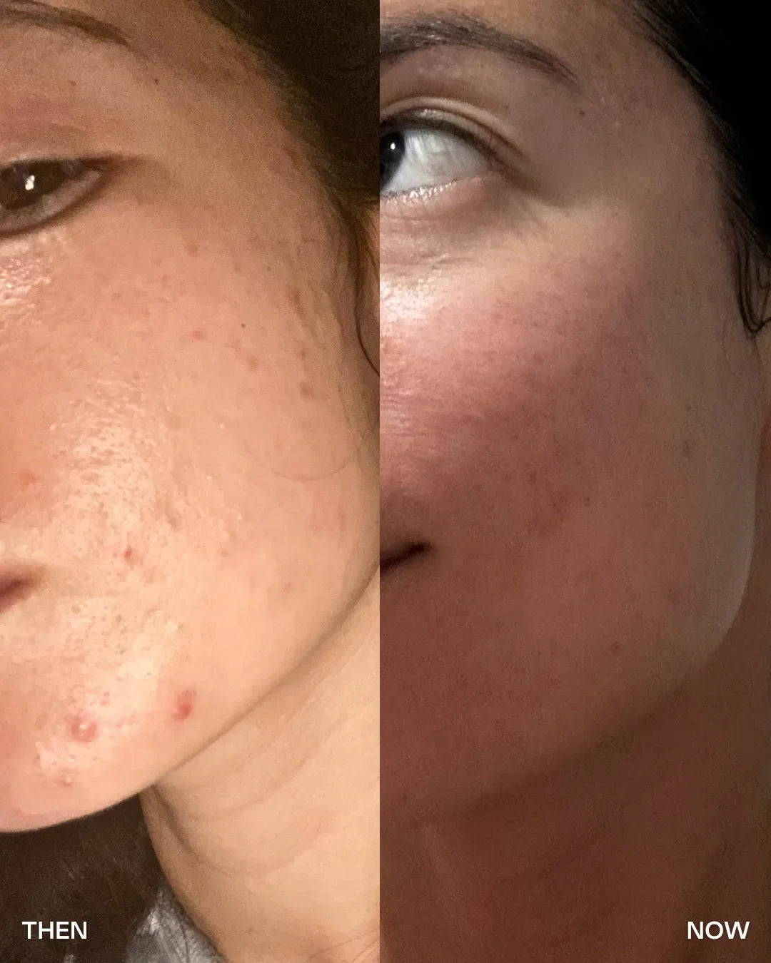 How to prevent pimples before they surface: Your bedtime-to-breakthrough routine