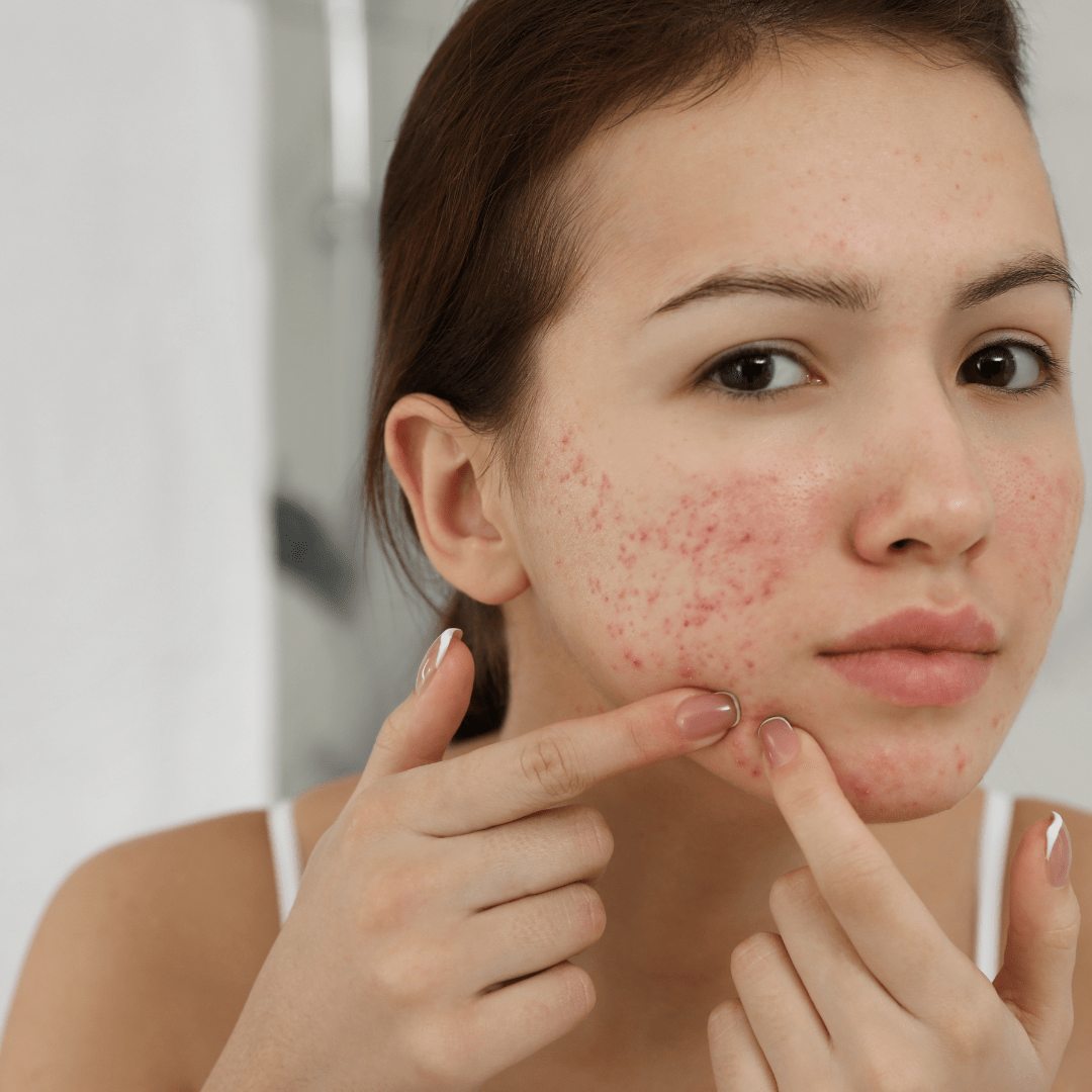 How to get rid of breakouts