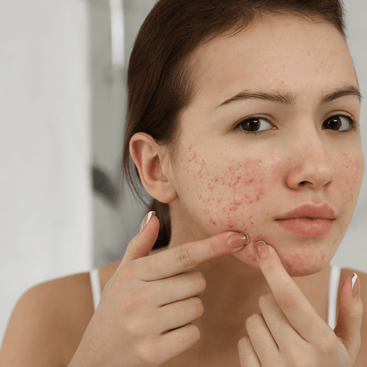 How to get rid of breakouts