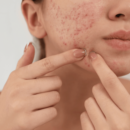 How to get rid of pimples